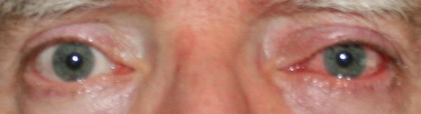My red eye